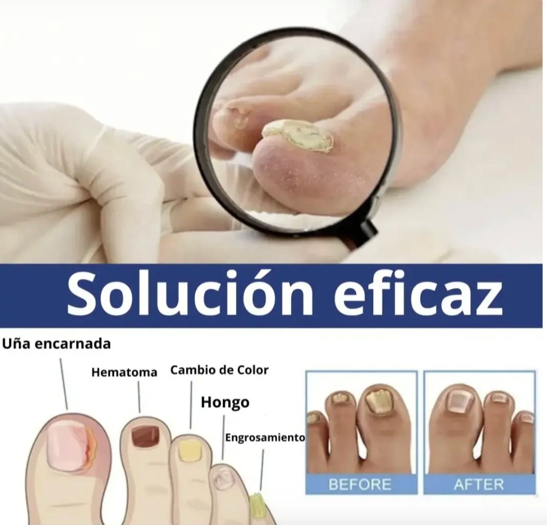 Parches AntiHongos 🩹 y Regeneradores De Uñas - FUNGAL NAIL PATCHES®💊