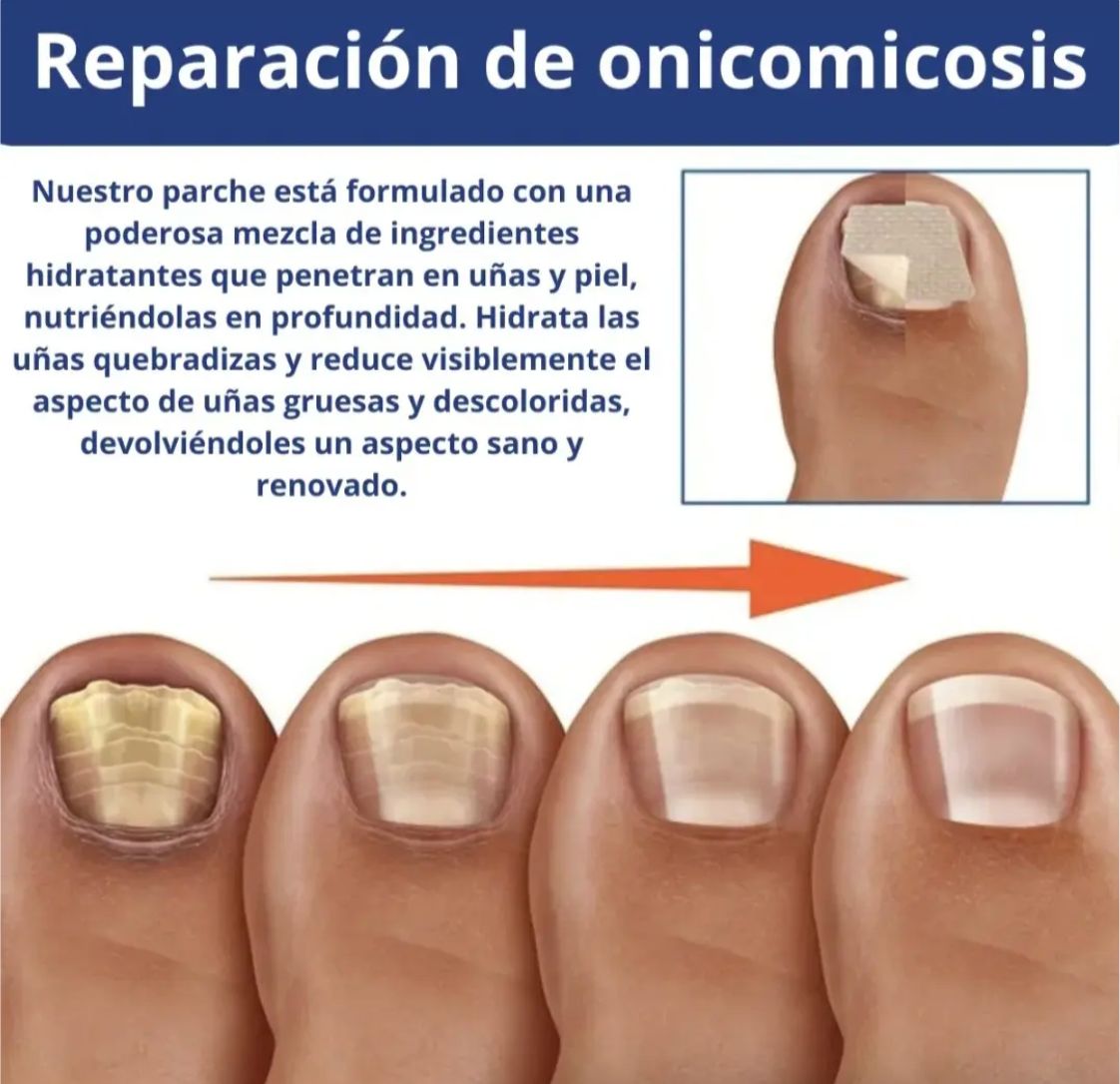 Parches AntiHongos 🩹 y Regeneradores De Uñas - FUNGAL NAIL PATCHES®💊