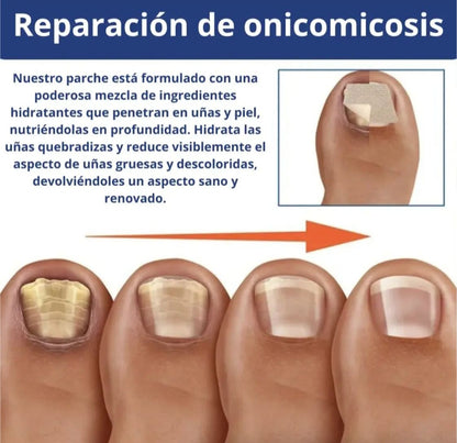 Parches AntiHongos 🩹 y Regeneradores De Uñas - FUNGAL NAIL PATCHES®💊